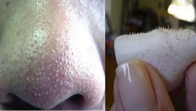 Photo of How To Get Rid Of Blackheads On Nose Fast At Home