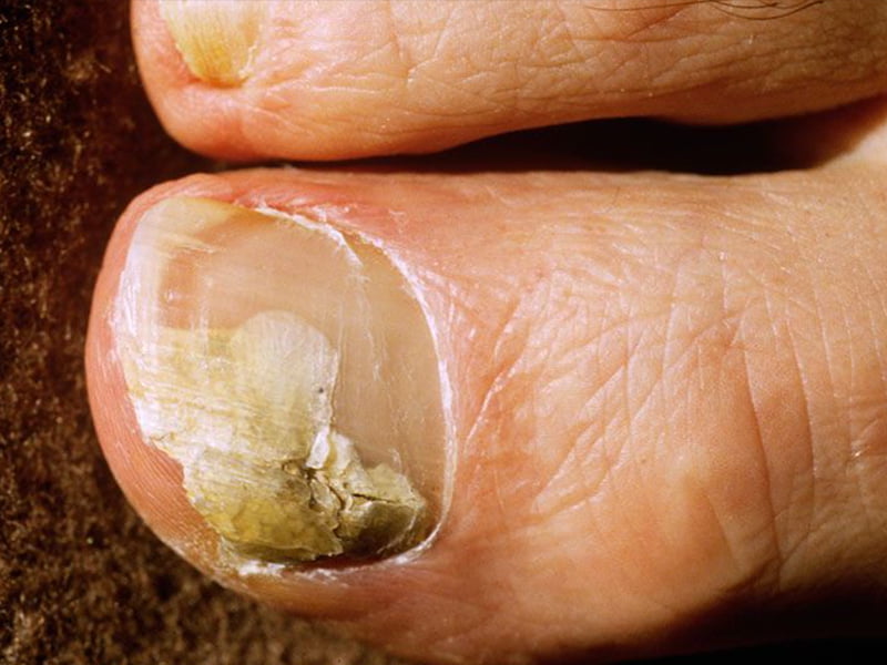 toenail-fungus-cure-how-to-get-rid-of-toenail-fungus-fast-at-home