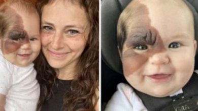 Photo of Mother wants to show 13-month-old daughter with rare birthmark how she is beautiful