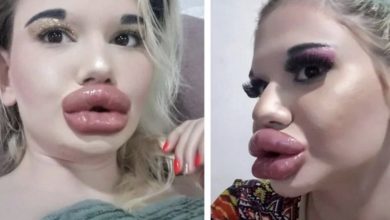 Photo of Surgeons Destroyed Her Appearance – See How a 22-Year-Old Girl Looked Before Undergoing Plastic Surgeries