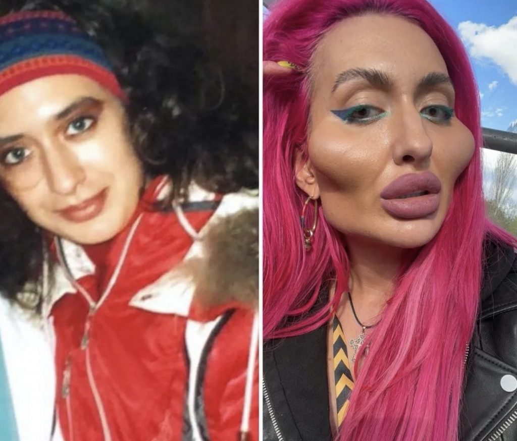 Unveiling the Woman with the World's Largest Cheekbones Before and ...
