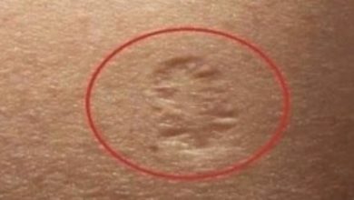 Photo of Do You Know What The Small Scar On Your Upper Left Arm Means?