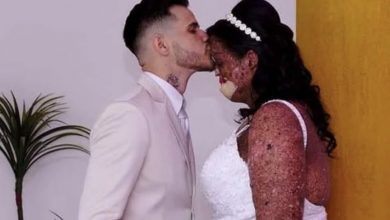 Photo of Woman with rare skin condition overcomes negativity and finds true love