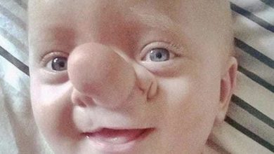 Photo of Nine years ago, a young girl was born with a distinctive “clown nose” appearance: Look at her current appearance and lifestyle