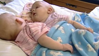 Photo of Conjoined twins were connected from birth, but surgery permanently changed everything