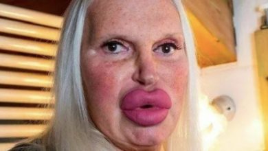 Photo of Women Who Dramatically Altered Their Appearance Through Excessive Lip Augmentation