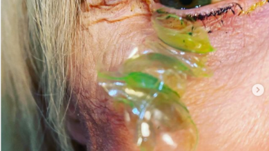 Photo of The Doctor Extracted 23 Stuck Contact Lenses From The Eye