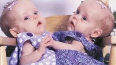 Photo of Conjoined Twins Bella And Abby Were Genuinely Associated From Birth, Yet Medical Procedure Changed Everything