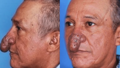 Photo of The Remarkable Transformation of Conrado’s Nose