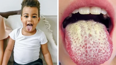 Photo of What Causes a White Tongue and How to Treat It