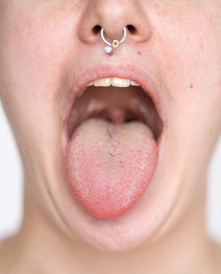 what-causes-a-white-tongue-and-how-to-treat-it-my-blog