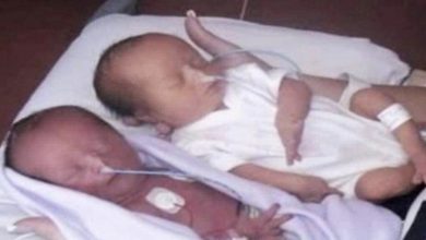 Photo of When Twin Girls Are Born They Are Full Of Joy, The The Doctor Says “I’m Sorry”