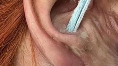 Photo of Weird substance removed from ear