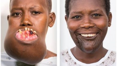 Photo of This Girls Stunning Transformation Unleashed Through Facial Surgery – Witness the Unbelievable Outcome