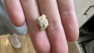 Photo of Here’s what you need to know about tonsil stones – the weird pimple-like growths in your throat